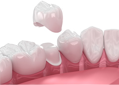 被せ物で歯の形態を修正