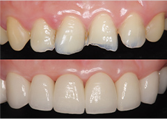 擦り減った歯を修復