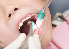 咬合調整（削合）による微調整