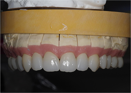 多数歯補綴治療