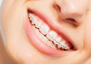 唇側ブラケット矯正（固定式装置）