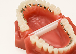舌側矯正（固定式装置）