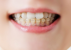 コンビネーション矯正