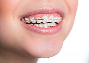 矯正治療（動的治療）の開始