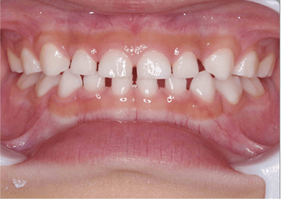 5歳 永久歯の萌出前