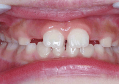 7歳 永久歯の萌出中