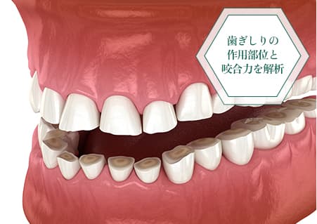 未来のリスクを防ぐ歯ぎしり治療