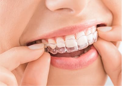 マウスピース治療