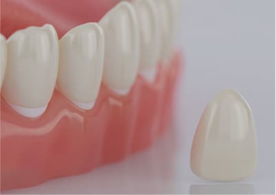 多数歯補綴治療