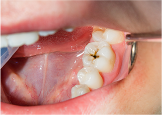 むし歯の治療はおまかせください