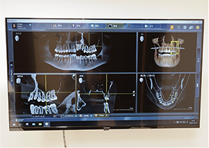 術前シミュレーション