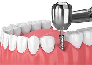 インプラント埋入手術
