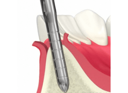 OAM（大口式）インプラントシステム