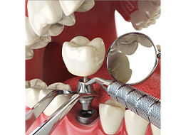 即時埋入インプラント手術
