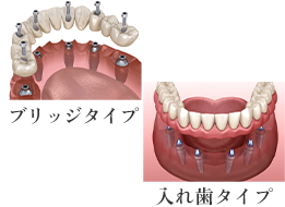 多数歯欠損に適した上部構造のご提案