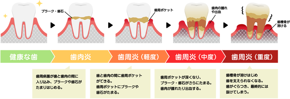 歯周病の症状と進行