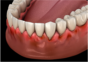 咬み合わせの力が歯周組織に与えるダメージ
