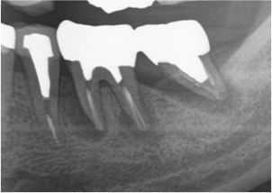 歯周病と咬み合わせが重なると起こる