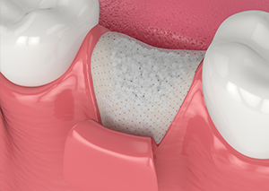 GTR法（組織再生誘導法）