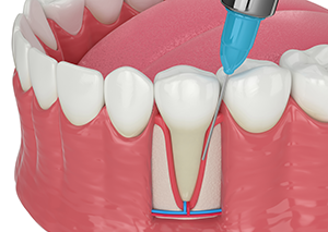 EMD法（エムドゲイン法）