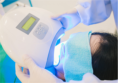 ポリリン酸オフィスホワイトニング