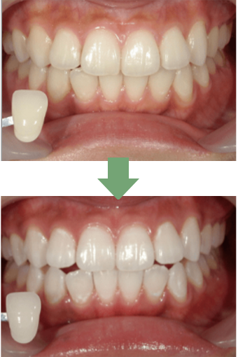ポリリン酸オフィスホワイトニング